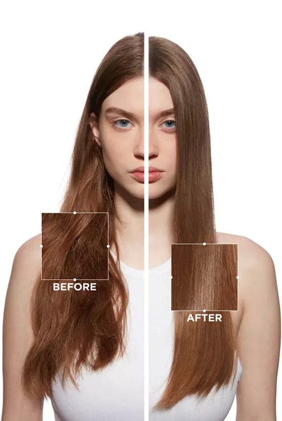 Before and after results of Fusio-Dose treatment