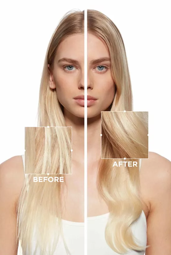 Before and after results of Fusio-Dose treatment