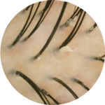 image of scalp under cross-polarised light